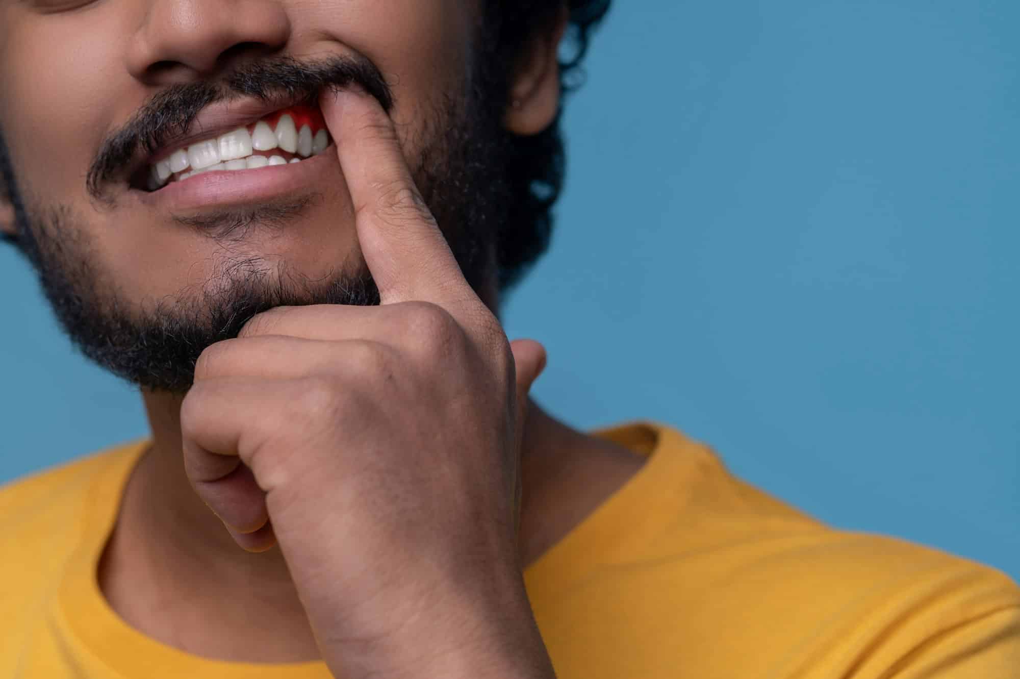 Adult man showing his periodontal disease before the camera